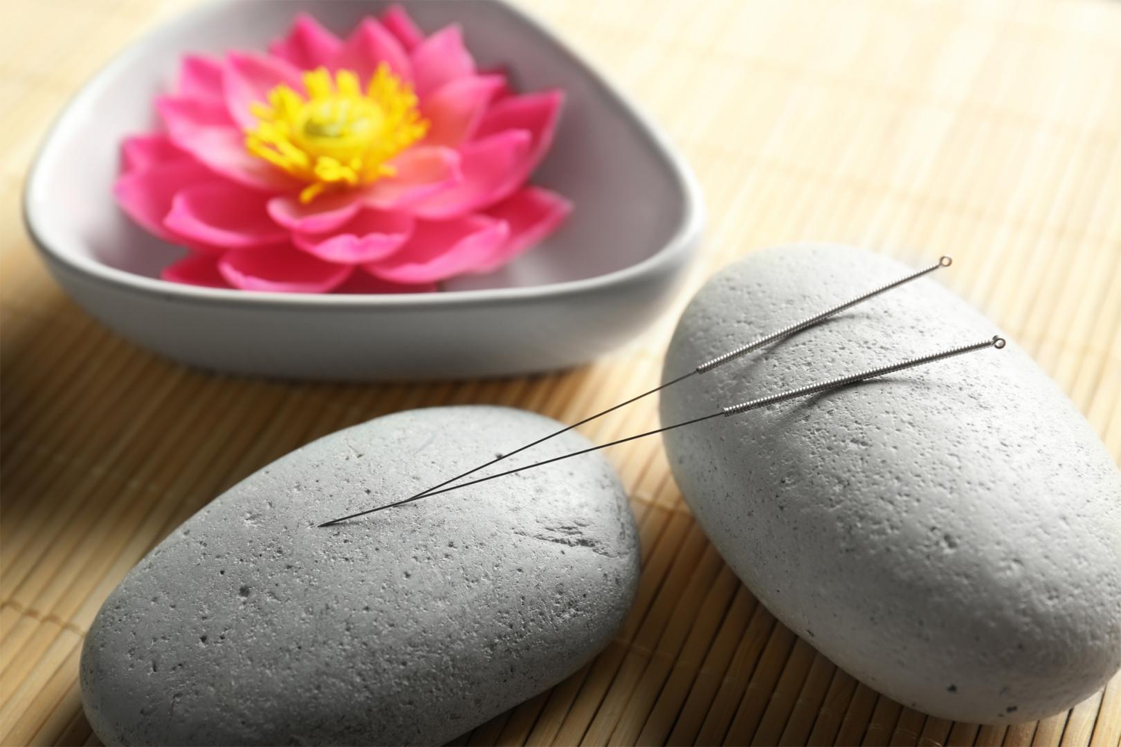 Acupuncture